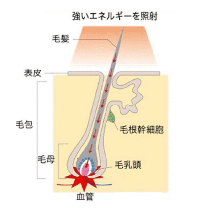 IPL方式（神戸脱毛の脱毛器）