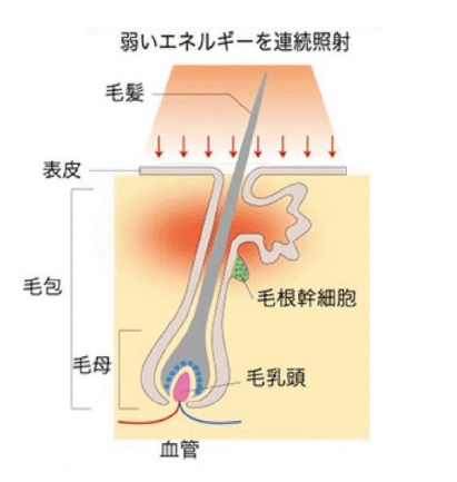 SHR方式（一般的な脱毛器）